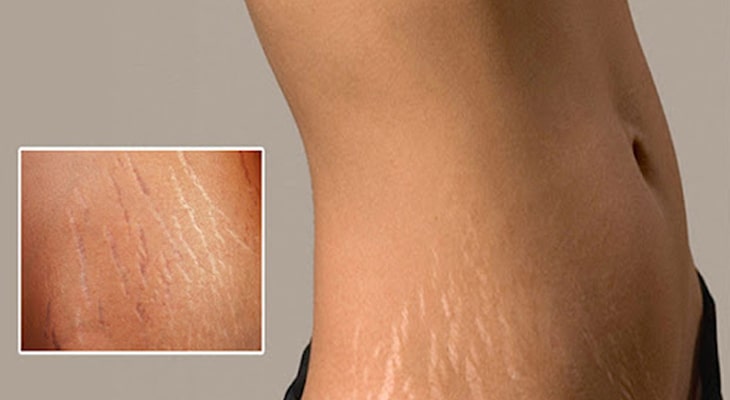 کربوکسی تراپی چیست؟