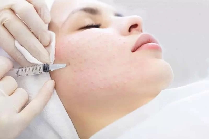 دورههای ترکیبی فیشیال پوست | فیشیال + میکرونیدلینگ، کربوکسیتراپی و مزوتراپی